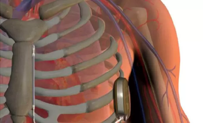 Στο American Medical Centre η πρώτη επέμβαση εμφύτευσης υποδόριου απινιδωτή στην Κύπρο